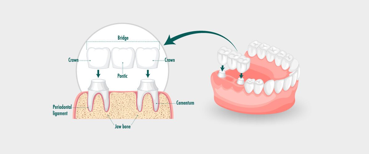 Dental Bridges
