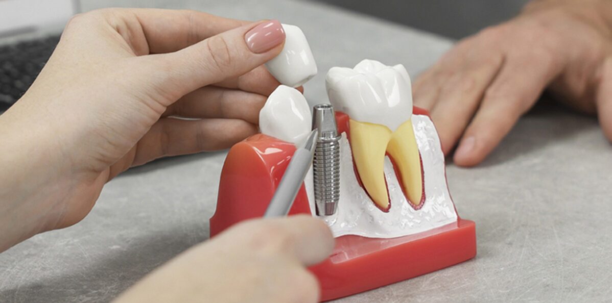 Dentist explaing dental implants procedure