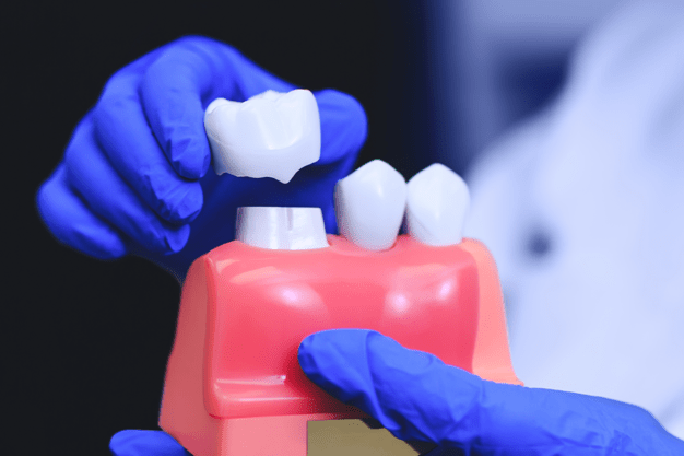 Dental-Crowns