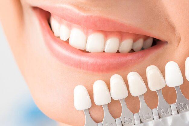 Dental Veneers