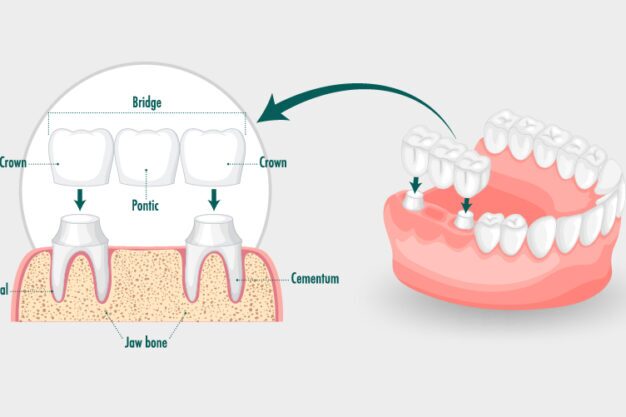Dental Bridges