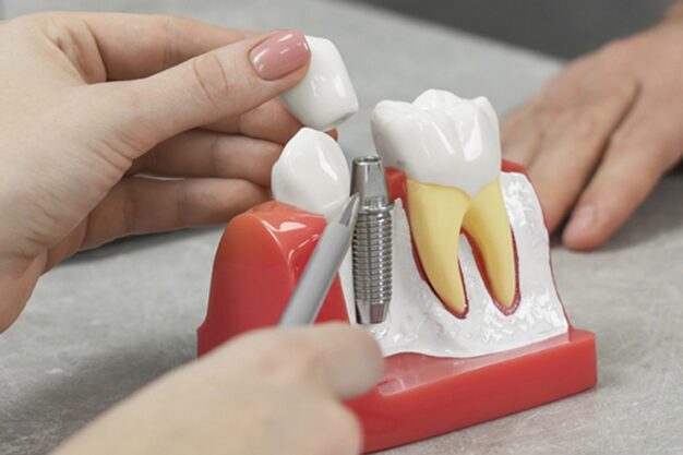 Dentist explaing dental implants procedure